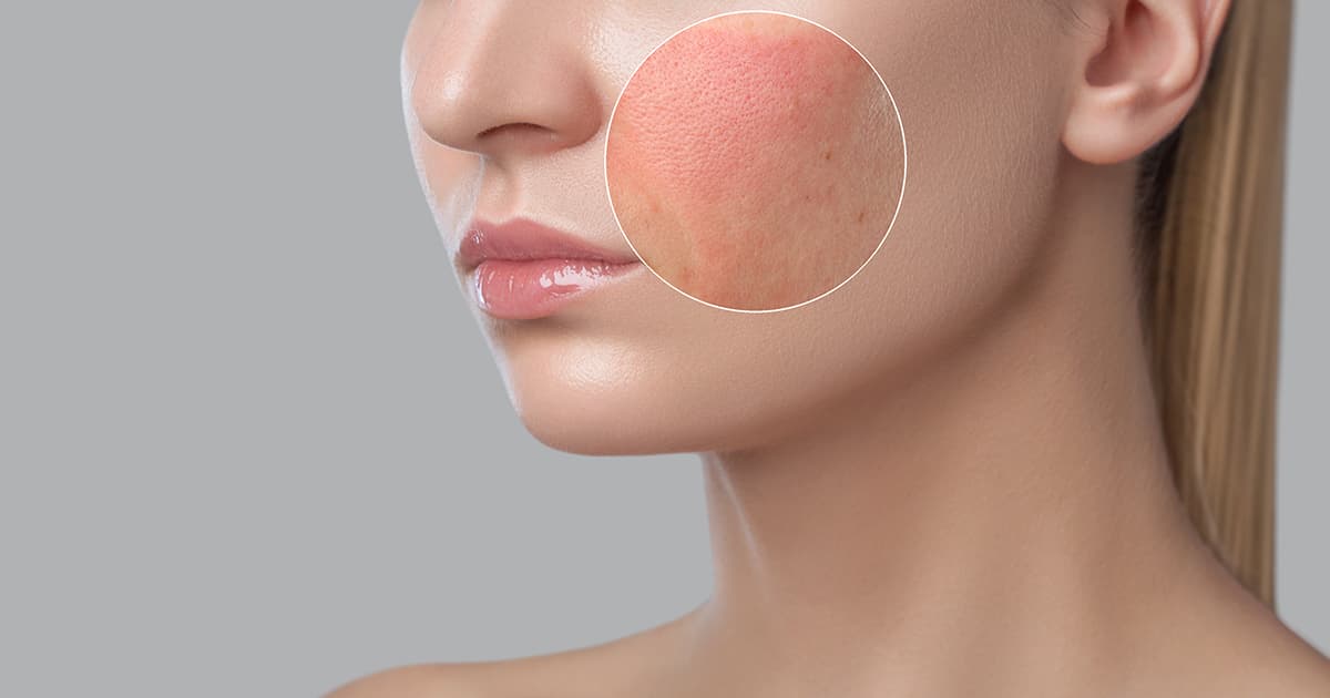 Lupus