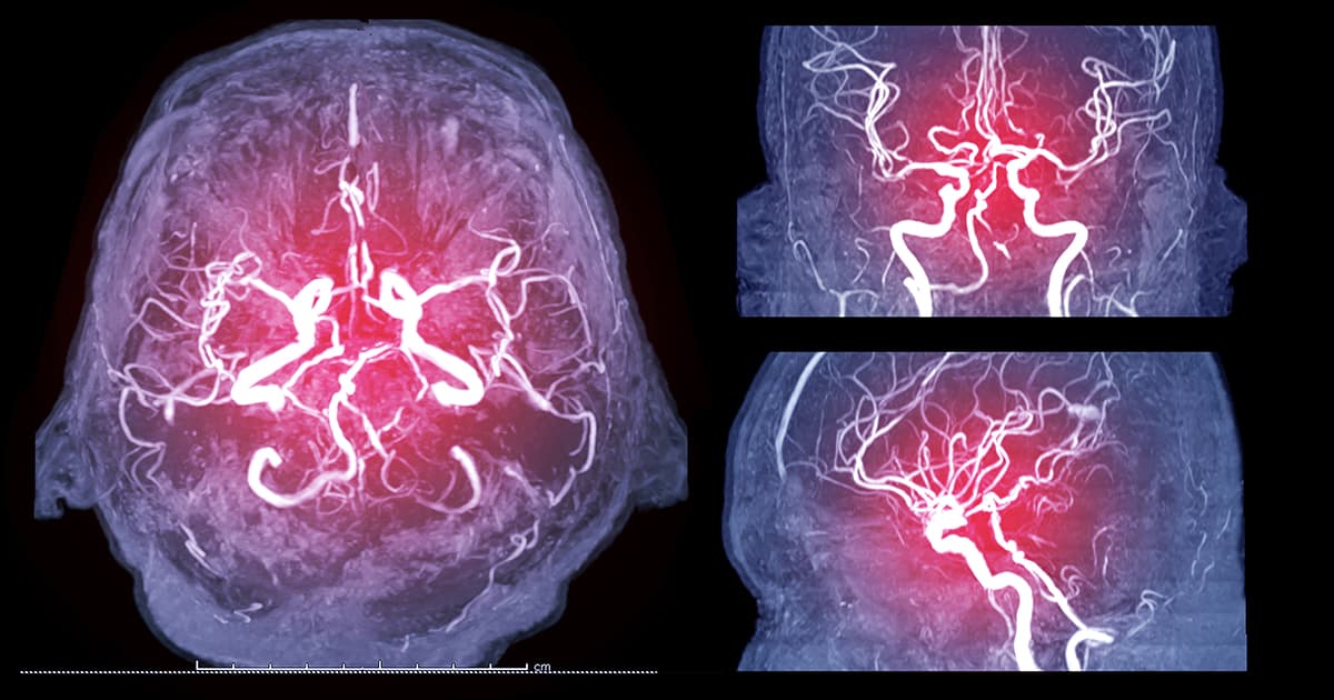Stroke classification: Ischemic and Hemorrhagic