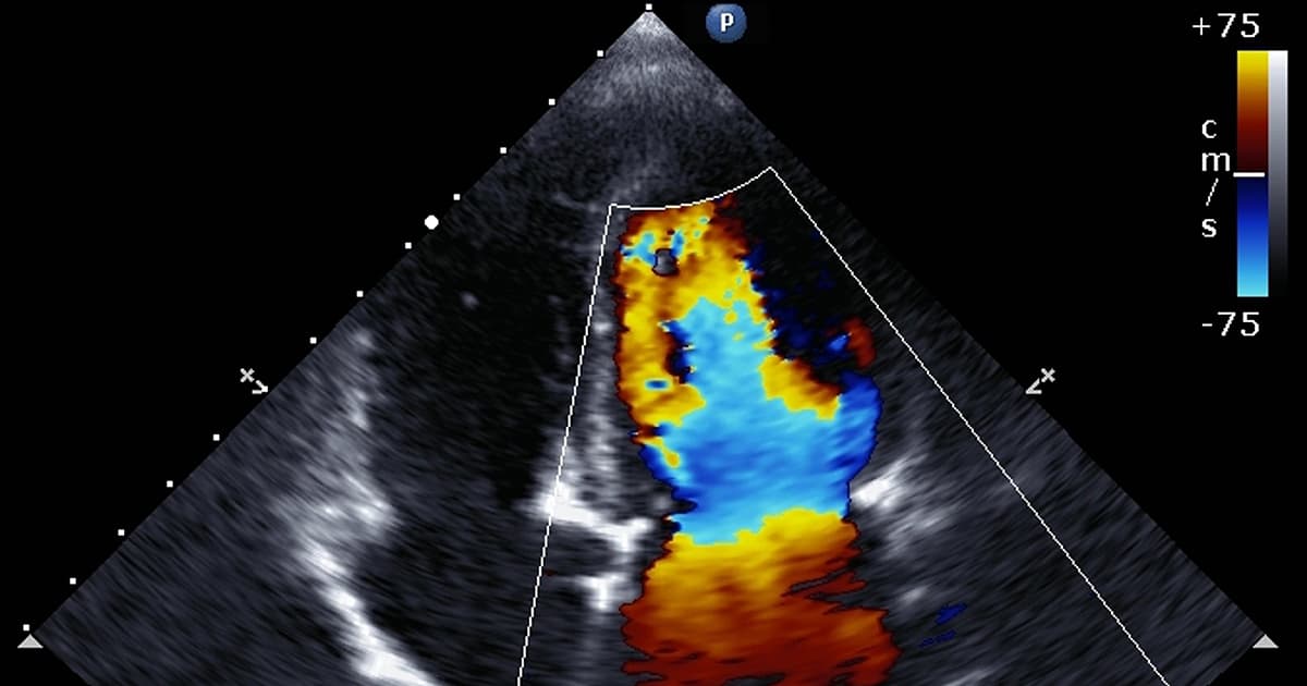 Echocardiograms