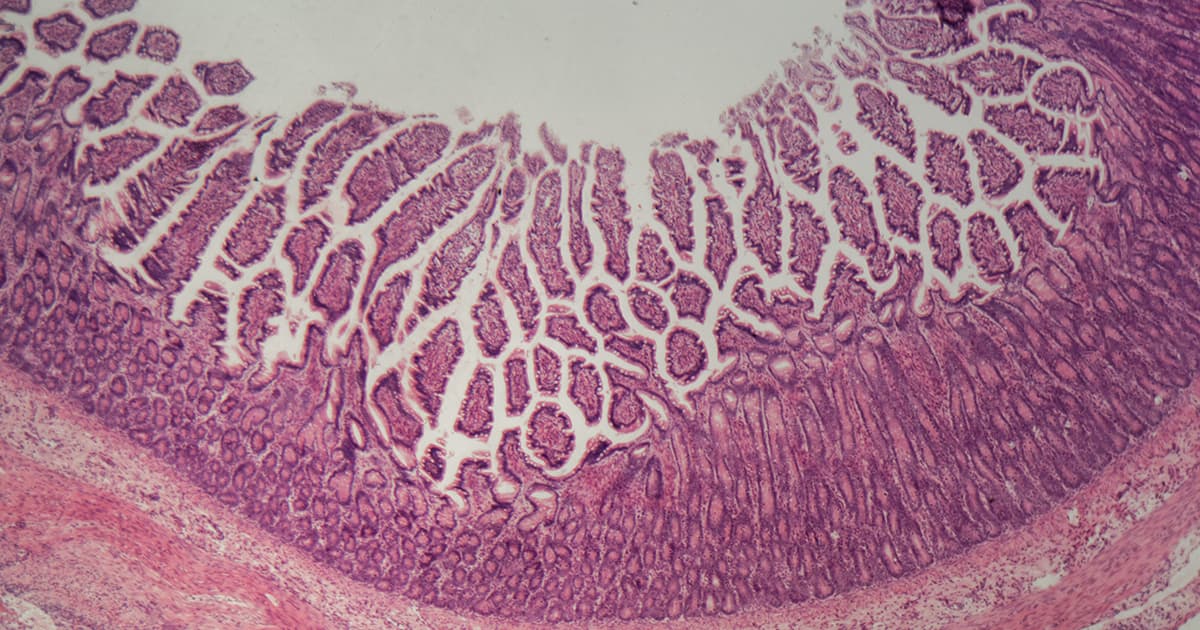 Inflammatory bowel disease